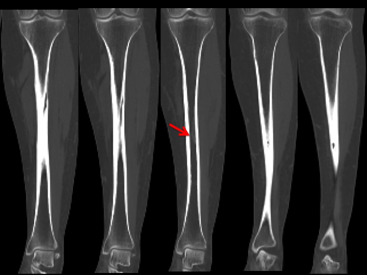 Figure 5 for case varix ( RID3366 )